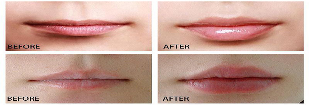 Champalou Spa Lip Enhancing Treatment