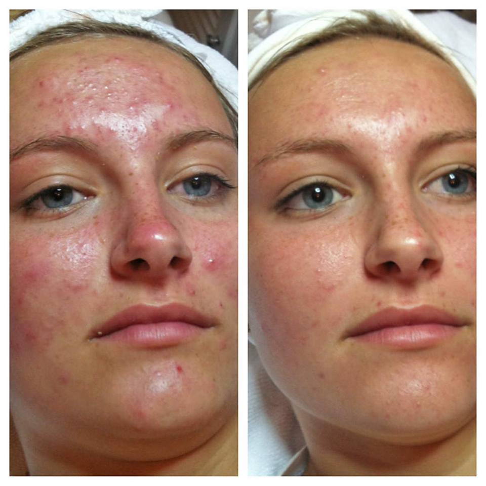 Champalou Spa Hydrafacial before and after
